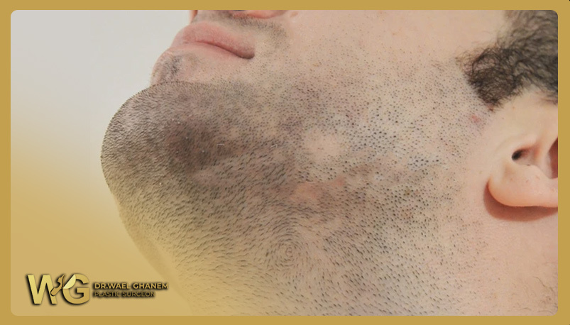 Beard Transplantation