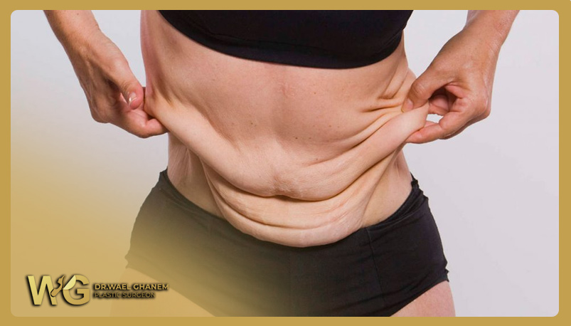 Body countering sfter bariatric surgeries