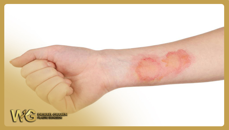 Burn injury treatment