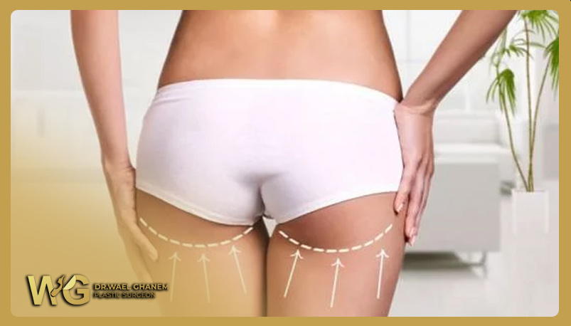 Buttock Lift for a More Attractive Appearance