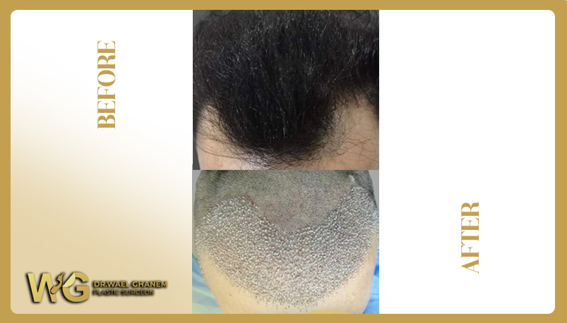 Hair transplantation gives youthful appearance