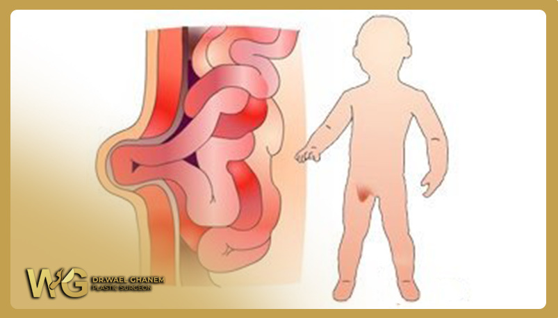 Inguinal Hernia