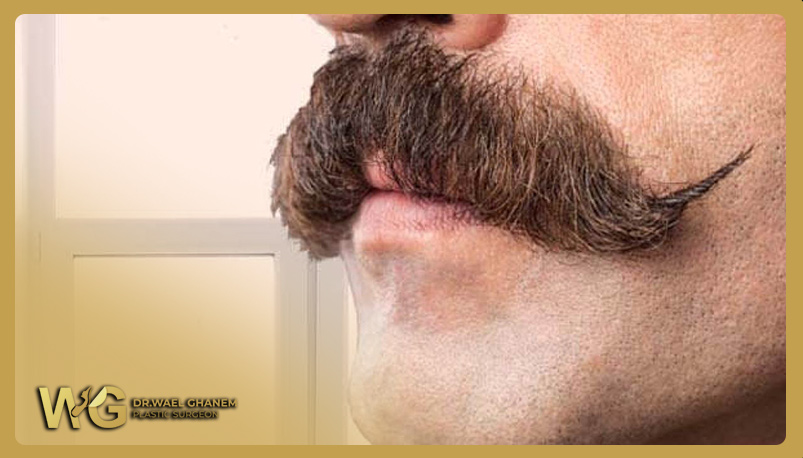 Mustache Transplantation