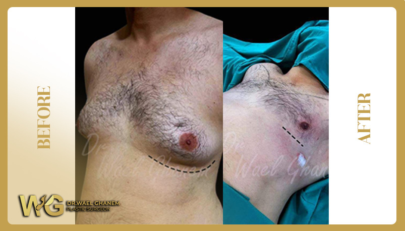 Permanent gynecomastia treatment with Dr. Wael Ghanem