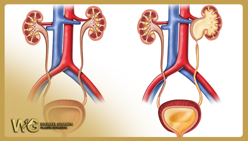 Renal pelvic obstruction