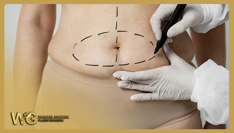 Tummy Tuck Procedure treat abdominal sagging