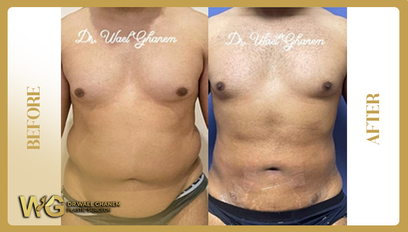 Eliminate stubborn fat with liposuction 